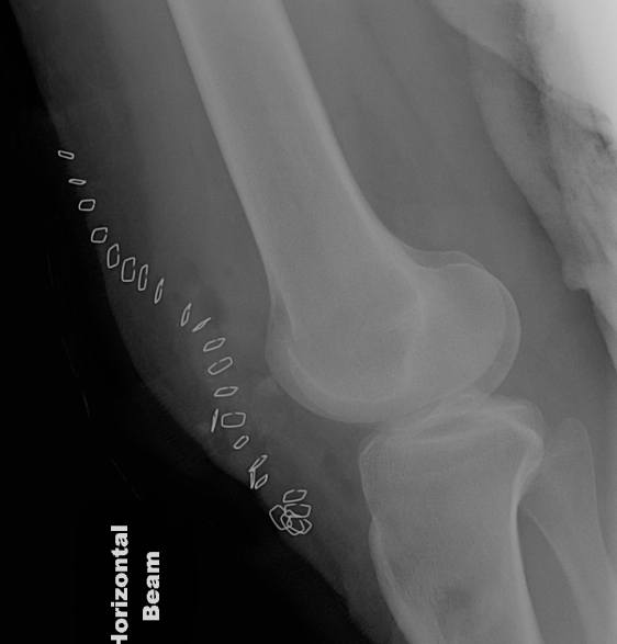 Patellectomy Lateral